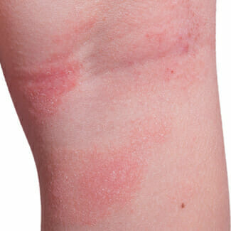 eczema-legs