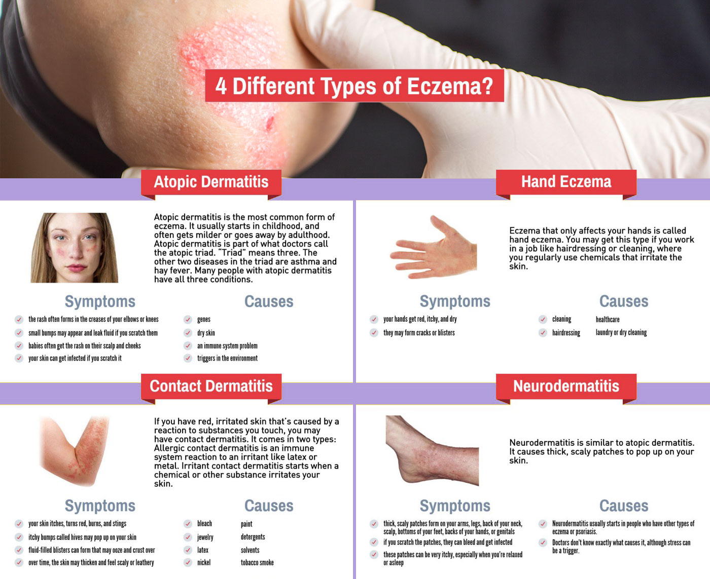 Dyshidrotic Eczema Overview Causes Diagnosis Pictures Eczema 900x600 Dyshidrotic Eczema Overview Causes Diagnosis Pictures Eczema 900x600
